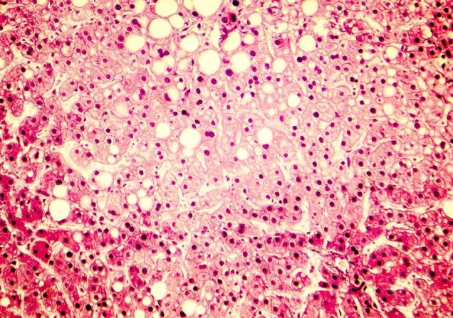 Fatty liver cells. Image by Kateryna Kon via Shutterstock