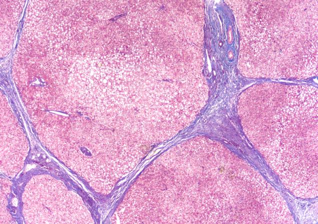 Photomicrograph of liver biopsy in a patient with cirrhosis. Image by David A. Litman via Shutterstock. 