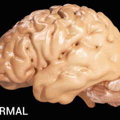 Alzheimer's Disease in the brain. Image courtesy of Doctor Jana. CC BY 4.0